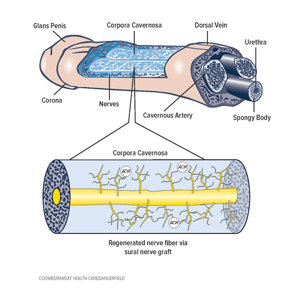 Erectile Disfunction Diagram