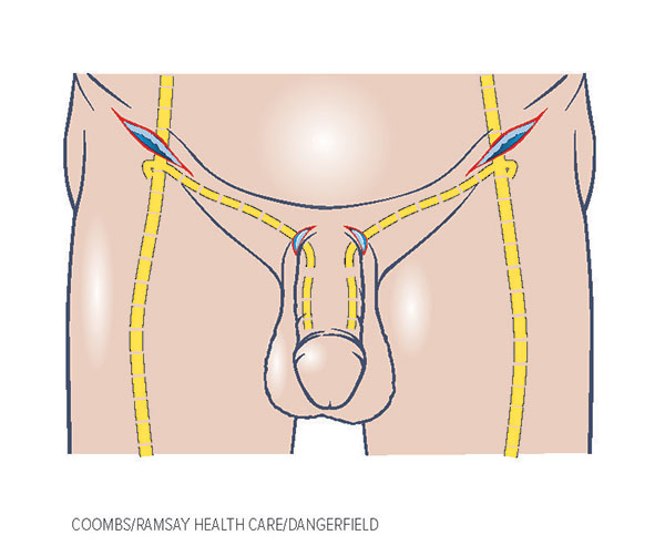 Erectile Disfunction Diagram